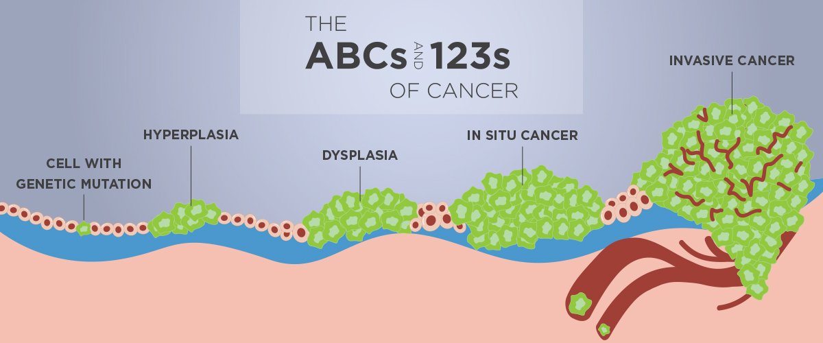 the-abcs-and-123s-of-cancer-stages-mary-bird-perkins-cancer-center