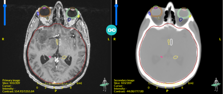 MRI scan (left); synthetic CT scan - using MR Box (right)