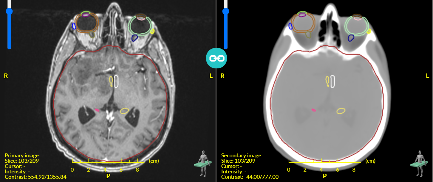 MRI scan (left); synthetic CT scan - using MR Box (right)