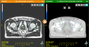 MRI scan (left); synthetic CT scan - using MR Box (right)
